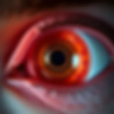 Anatomy of Acute Angle Glaucoma Diagram illustrating the anatomy of the eye affected by acute angle glaucoma