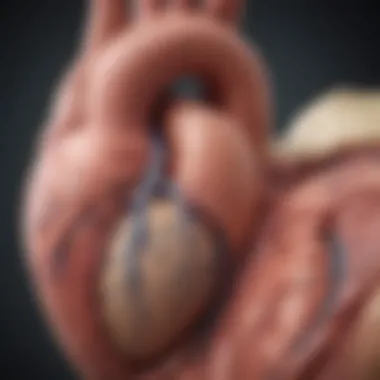 Anatomy of the Severely Dilated Left Ventricle Illustration of a heart showing a severely dilated left ventricle